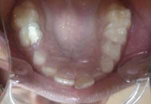 Paciente de 9 años Perdida prematura del 54 por caries dental