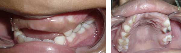 Paciente de 7 años pérdida prematura del 64 por caries dental