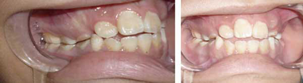 Paciente de 9 años pérdida prematura del 53 por caries dental