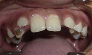 Paciente de 8 años pérdida prematura del 63 por caries dental