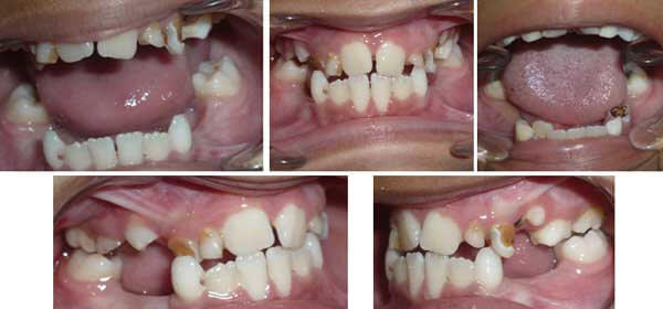 Paciente de 8 años pérdida prematura de 74-75-84-85 por caries dental