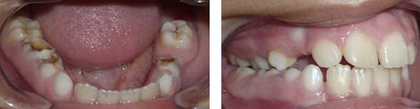 Paciente de 8 años pérdida prematura del 75 y 53 por caries dental