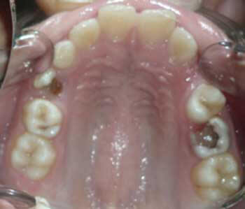 Paciente de 9 años pérdida prematura del 53 por caries dental