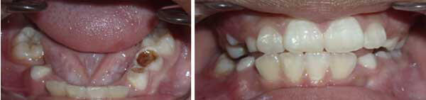 Paciente de 8 años pérdida prematura del 73-83-85 por caries dental