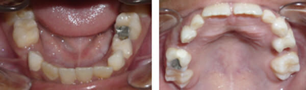 Paciente de 8 años pérdida prematura de 54-65-84 por caries dental