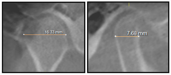Figura 1 Fuente propia CESO Medida de los cóndilos de un paciente asimétrico en el plano frontal y anteroposterior. Nótese que las medidas son hechas por medio de la ayuda dada por el software Galileos.