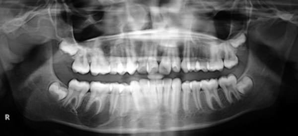 Figure 1 Orthopantomogram showing unilocular radiolucent area on the right side of the body of mandible.