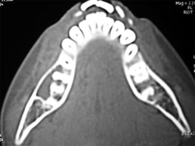 Figure 2 CT section showing the extension of the lesion