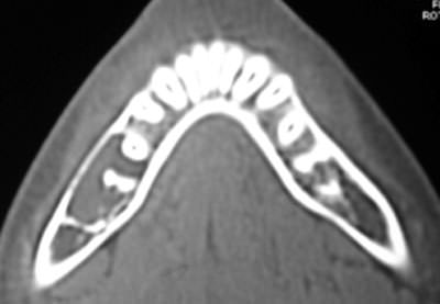 Figure 3 CT section showing buccal cortical expansion and thinning