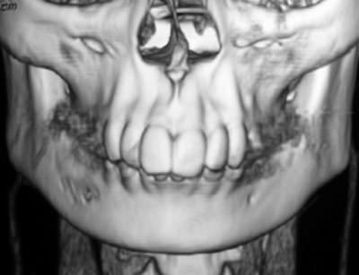 Figure 4 Three dimensional reconstruction shoes cortical changes around the mental foramen on the right side.
