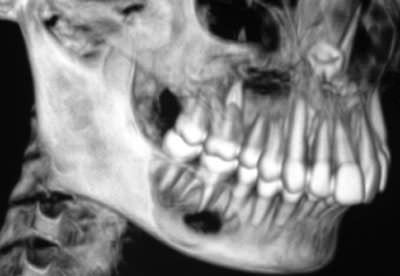 Figure 5 Showing the precise extension of the lesion