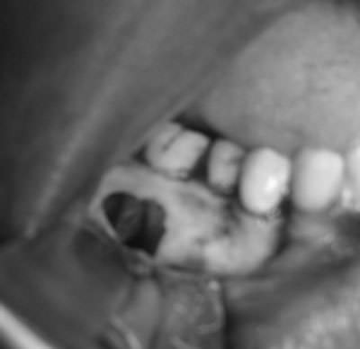 Figure 6 Surgical exploration of the site showing hollow cavity