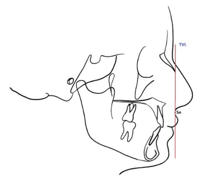 Figura 1. Representación esquemática de la True Vertical Line (TVL) descrita por Arnett, trazada perpendicular a la horizontal verdadera y pasando por el punto subnasal (Sn), utilizada como referencia para evaluar las relaciones anteroposteriores del perfil facial.