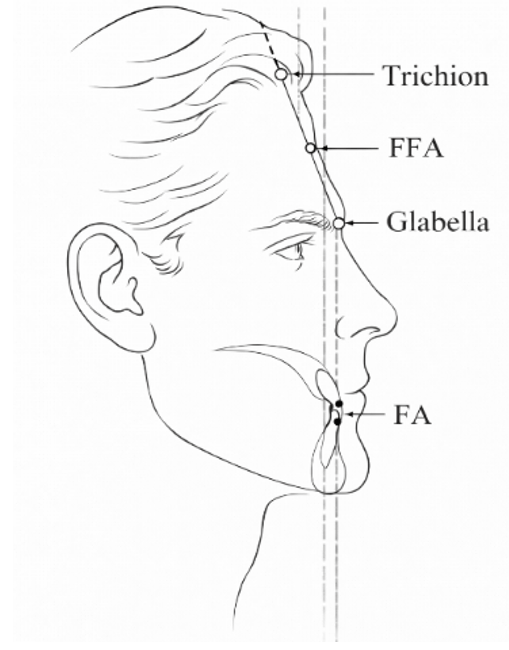 Figura 2. Puntos anatómicos utilizados en el análisis frente–incisivo de Andrews. Se identifican Trichion, FFA y Glabela, así como el punto facial del incisivo superior (FA). La posición sagital del incisivo se determina mediante la distancia horizontal entre el punto FA y la vertical que pasa por el FFA.