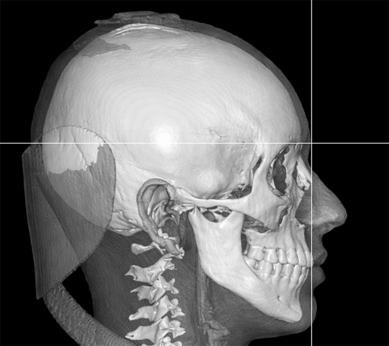 Figura 3. Reconstrucción tridimensional lateral de CBCT que muestra el trazado de la Línea Barcelona como referencia vertical facial para evaluar la proyección sagital del maxilar superior en relación con el perfil de tejido blando.