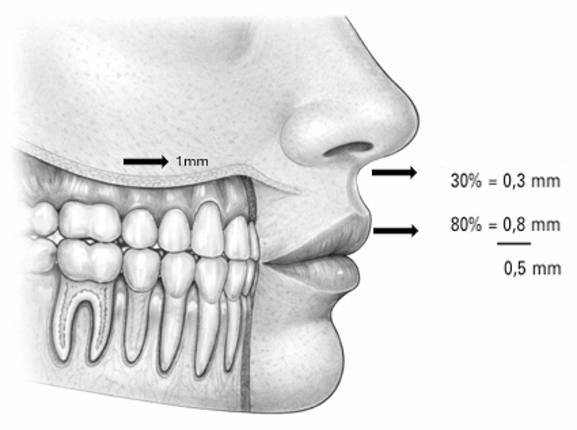 Figura 4. Representación esquemática del desplazamiento del tejido blando del labio superior y punto subnasal en relación con el avance del maxilar.