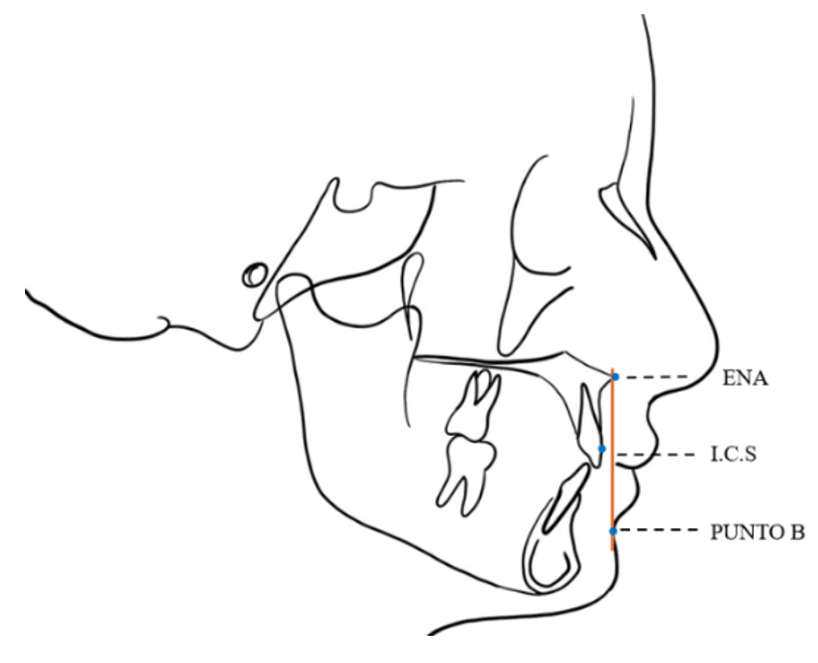 Figura 5. Línea de Raffaini. Evaluación en posición natural de cabeza donde la Espina Nasal Anterior (ENA) actúa como referencia anatómica para determinar la proyección anteroposterior del incisivo central superior (I.C.S) y su relación con el soporte labial.