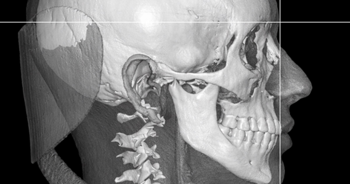 Planos de referencia para el posicionamiento del maxilar superior en Cirugía Ortognática