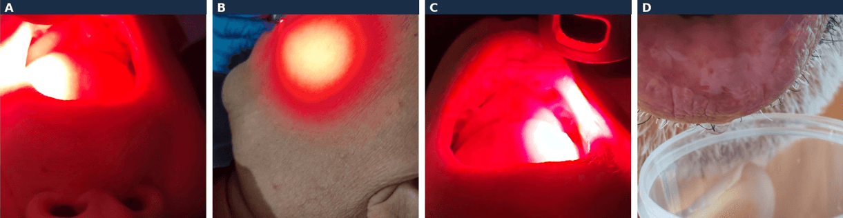 Figura 3. Detalle de la aplicación de biofotomodulación intraoral y extraoral sobre la mucosa yugal y la región submandibular, ilustrando el sitio de acción propuesto para la modulación directa e indirecta de la microbiota oral descrita en el texto. Fotografías propias de los autores.