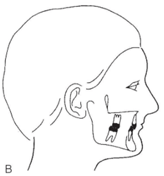 Figura 1. Representación esquemática del perfil lateral (Tipo B) en la maloclusión Clase II división 2, mostrando la relación distal molar y la retroinclinación de los incisivos superiores. Tomada de Kopp S.