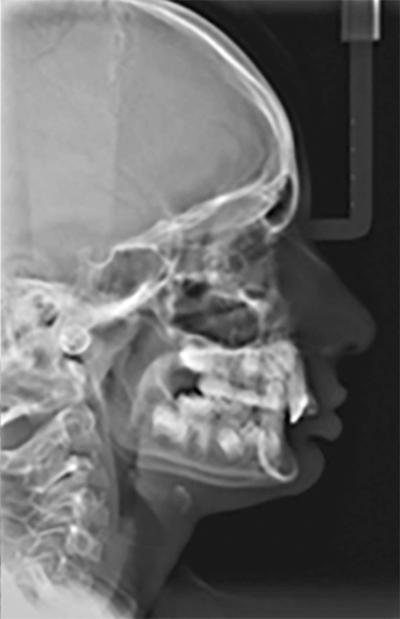 Figura 3. Telerradiografía lateral de cráneo de paciente en crecimiento con maloclusión Clase II división 2, que evidencia retrusión mandibular y sobremordida esquelética. Tomada de Verma RK, Singh SP, Verma S (2022) (ref. caso clínico).