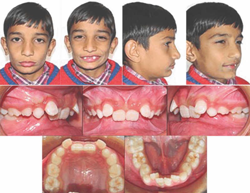 Figura 4. Registros fotográficos faciales e intraorales de un paciente pediátrico en dentición mixta con maloclusión Clase II división 2, previo al tratamiento interceptivo. Tomada de Verma RK, Singh SP, Verma S (2022) (ref. caso clínico).