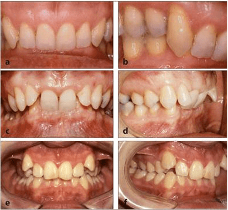 Figura 2. Fotografías intraorales clínicas (vistas frontal, lateral derecha, lateral izquierda, oclusal superior e inferior) que ilustran las características dentales de la maloclusión Clase II división 2: retroinclinación de incisivos superiores y sobremordida profunda anterior. Tomada de Luzuriaga A, Siguencia V, Bravo Calderón M (9).