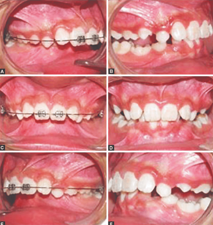Figura 6. Secuencia fotográfica intraoral (vistas A-F) pre y postratamiento con aparatología fija en paciente con maloclusión Clase II división 2, evidenciando la corrección sagital y la normalización del overjet y overbite. Tomada de Giuntini V, McNamara JA Jr, Franchi L (11).