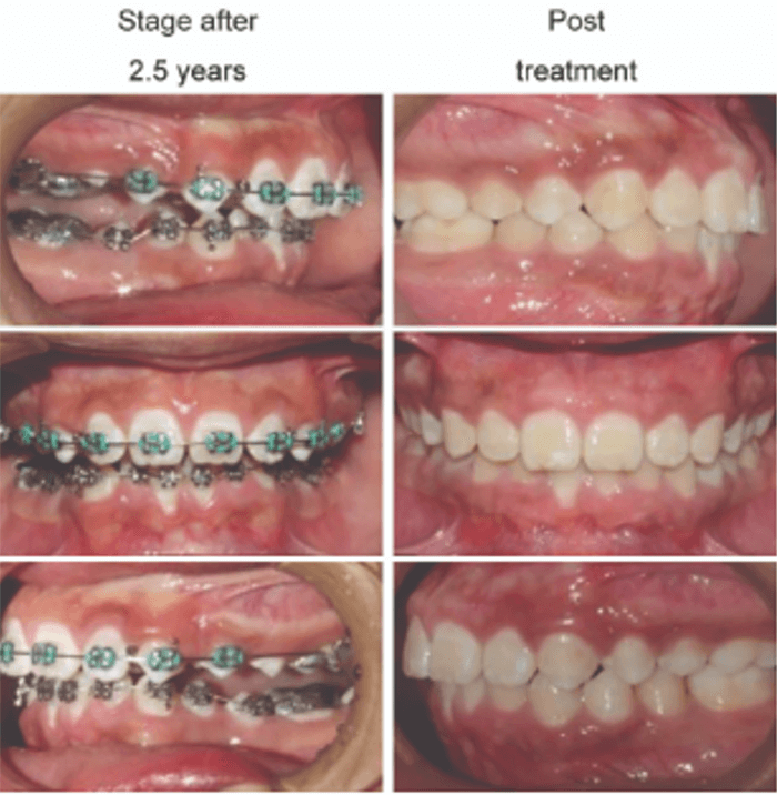 Figura 7. Fotografías intraorales que ilustran el uso de expansor maxilar (disyuntor) y aparatología fija en la fase de tratamiento interceptivo transversal en dentición mixta, orientado a la corrección espontánea de la Clase II. Tomada de Castro ZM, Zambrano BM (5).