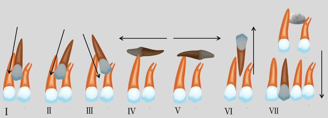 Figure 1. Yamamoto classification of maxillary impacted canines.