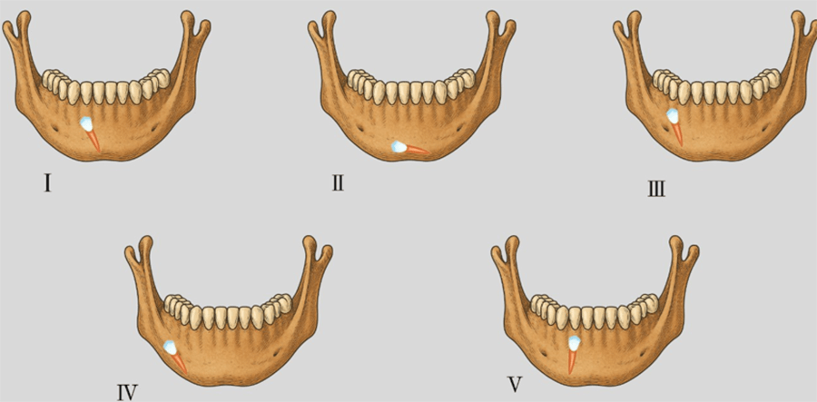 Figure 2. Mupparapu classification of transmigrated mandibular canines.