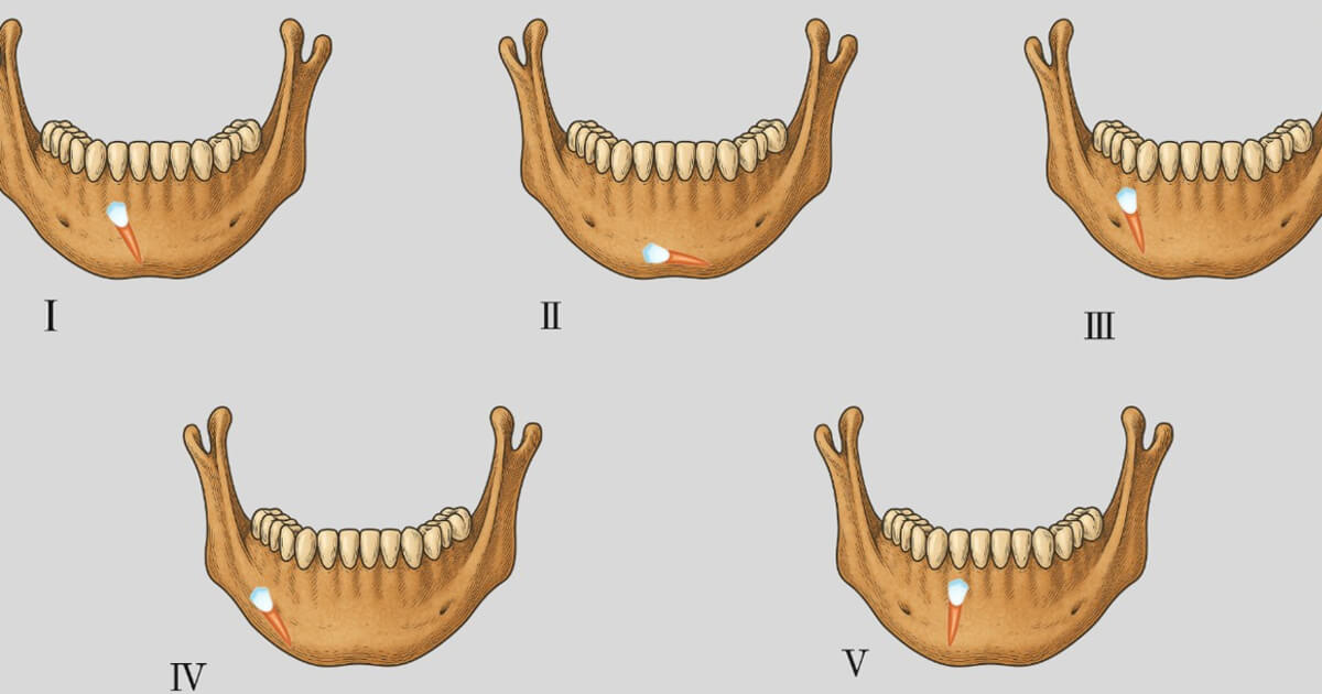 Prevalence and Patterns of Impacted Canines: A Retrospective Study of Panoramic Radiographs in Northeastern Brazil