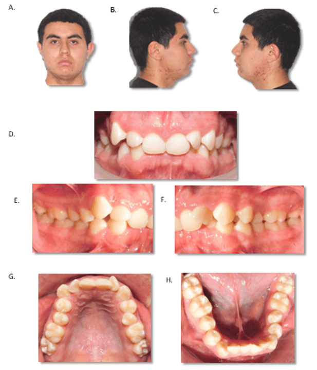 Figura 1. Fotografías clínicas. Fotografías extra orales: A) frontal, B) lateral derecha, C) lateral izquierda; fotografías intraorales: D) frontal, E) lateral derecha, F) lateral izquierda G) oclusal superior, H) oclusal inferior.