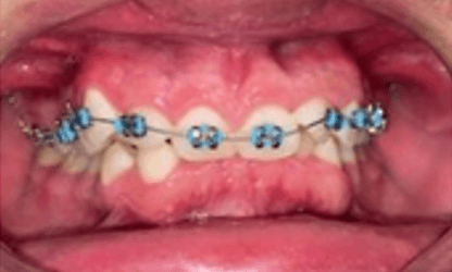 Figura 2. Inicio de tratamiento de ortodoncia, brackets MBT 0.018 en incisivos centrales superiores, colocados de forma invertid y arco 0.012 de NiTi.
