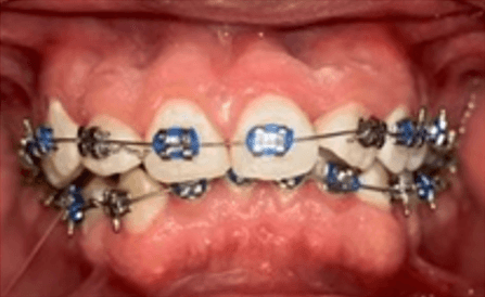 Figura 4. Colocación de brackets inferiores y arco curva inversa 0.016 NiTi.