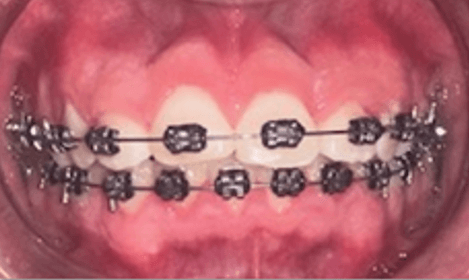 Figura 5. Estado actual del tratamiento. Brackets MBT slot 0.018, arco 16x16 NiTi superior e inferior.