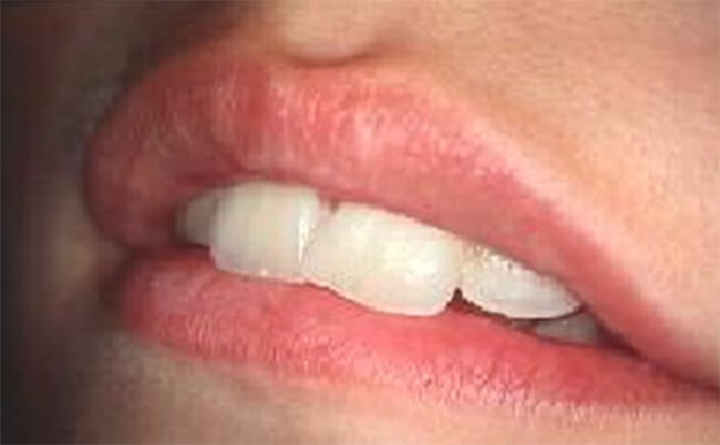 Fig. 5: Hábito de succión Labial.