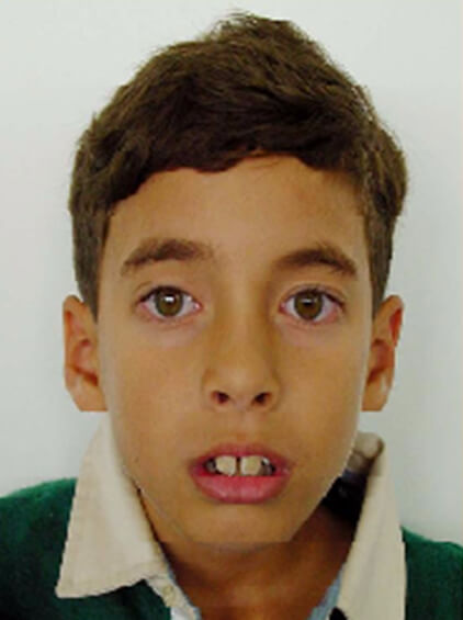 Fig. 6: Paciente Respirador Oral.