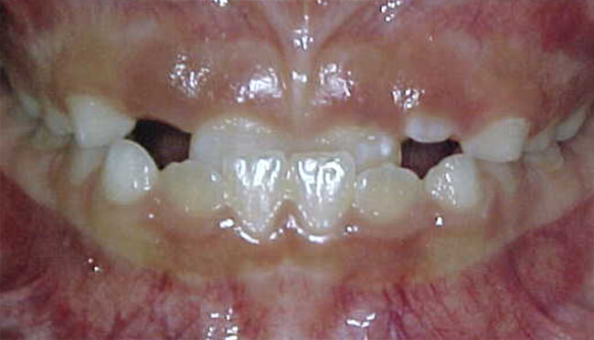Fig.3 Mordida cruzada anterior