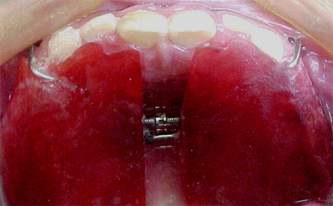 Fig. 4 Colocación de Hass modificado, con ganchos para tracción.