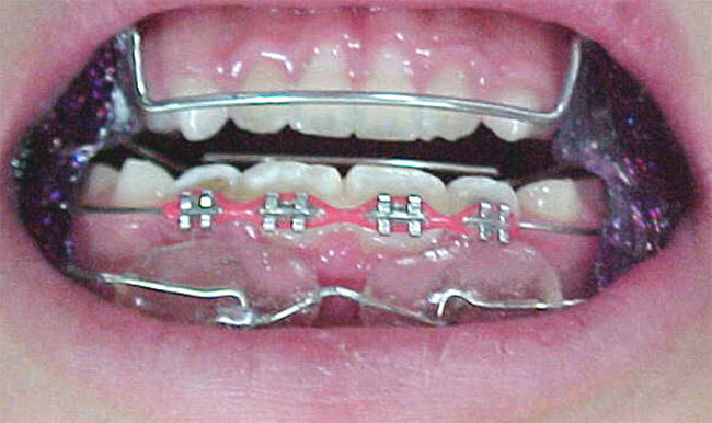 Fig.10 Colocación de R F3