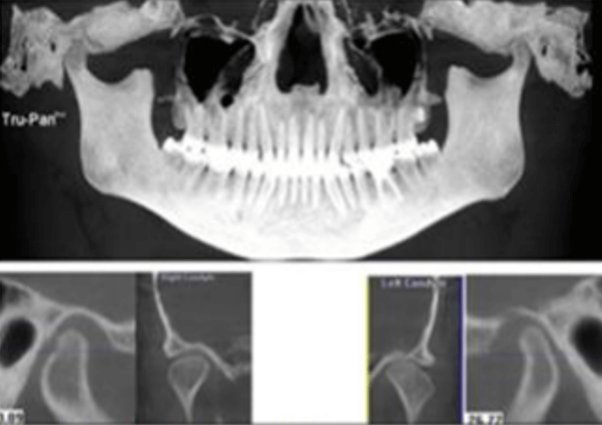 Fig 6. Toma de imagen con CBCT revela superficies óseas irregulares. Extraído de: Journal of Advanced Clinical and Research Insights (2019) 