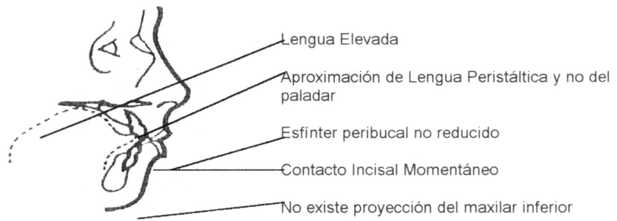 Deglución Madura o Infantil